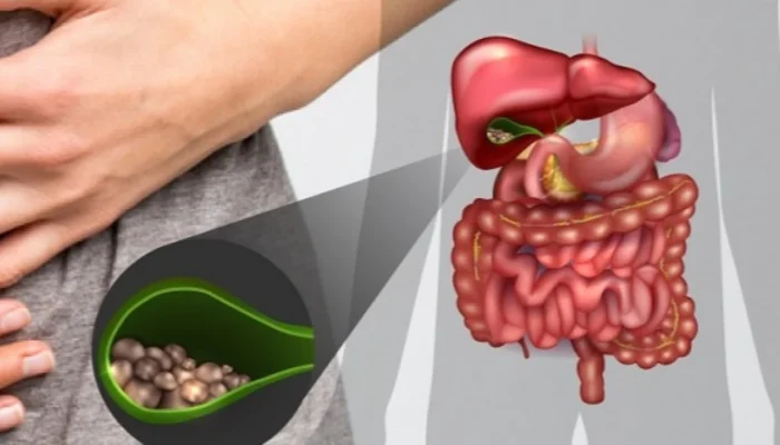 Waspada! Ini 5 Makanan Pemicu Batu Empedu yang Sebaiknya Dikurangi Sejak Dini