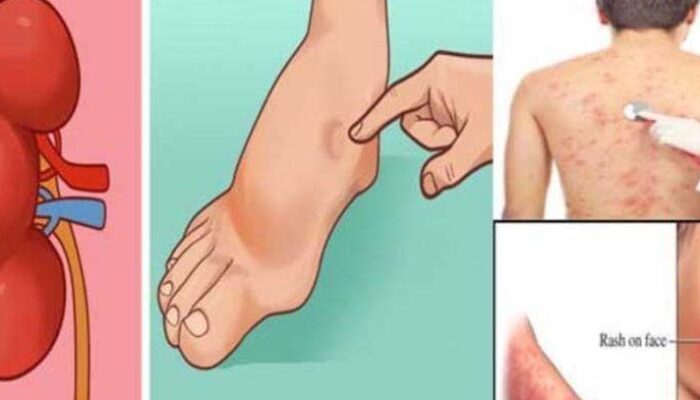 Waspadai 5 Tanda Gagal Ginjal yang Muncul di Kaki, Bisa Jadi Pertanda Serius